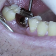 Video: Rugby players receive tooth implant that doubles as a bottle opener