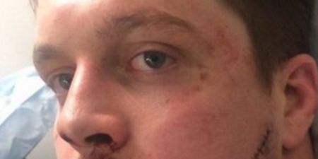 GRAPHIC: Worcester prop suffers one of the most stomach-churning cuts you’ll ever see