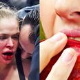 Ronda Rousey: My jaw is so f*cked I can’t even eat an apple
