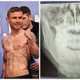 Scott Quigg fought eight rounds of his defeat to Carl Frampton with a very painful injury