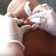 This guy’s 30-year-old cyst being popped is even more disgusting than you could ever imagine