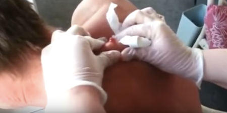 This guy’s 30-year-old cyst being popped is even more disgusting than you could ever imagine