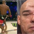 ‘Cyborg’ Santos shares photographs of his fractured skull after 7-hour surgery