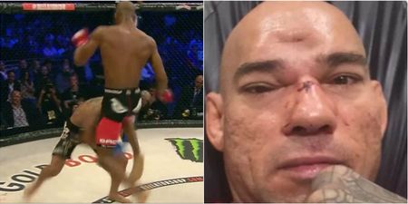 ‘Cyborg’ Santos shares photographs of his fractured skull after 7-hour surgery