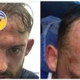 Steven Fletcher’s horrific head gash is not for the squeamish
