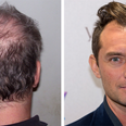 14 things a man goes through when he starts losing his hair