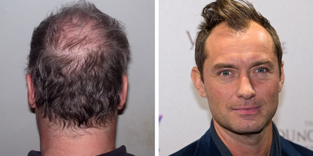 14 things a man goes through when he starts losing his hair