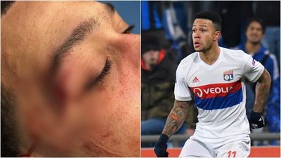 Memphis Depay shows off nasty cut picked up in dramatic win
