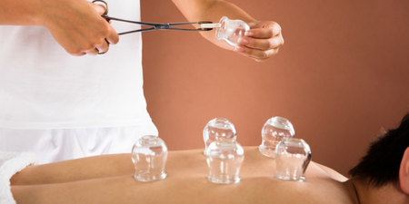 Does ‘cupping’ work, or is it a fashionable fad? A doctor weighs in
