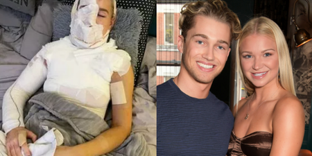 AJ Pritchard’s partner, Abbie Quinnen, pictured for first time since suffering third degree burns