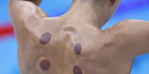 What are the dark circles on swimmers’ backs at Tokyo Olympics?