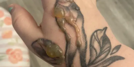 Woman horrified after warts grew on tattoo and had to be burned off