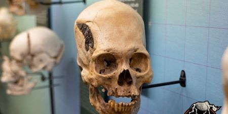 2,000 year old skull held together by metal offers evidence of ancient surgery