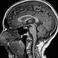 Covid brain can cause brain to shrink, new study finds