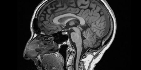 Covid brain can cause brain to shrink, new study finds