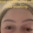 Woman pushed so hard while giving birth that her eye ‘popped out’