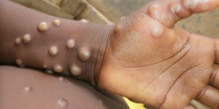 Monkeypox: Two more people diagnosed in the UK
