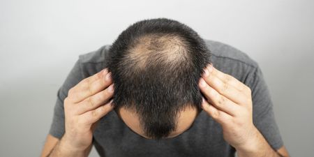 Great news for bald men as new drug successfully regrows hair in 40% of patients