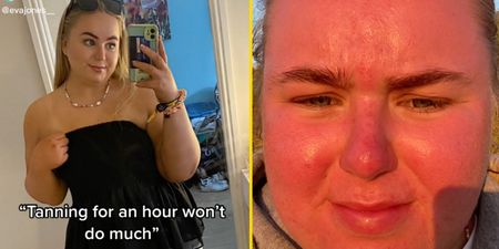 Woman’s face ‘doubles in size’ after spending just an hour in the sun