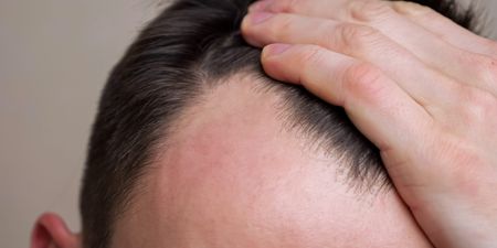 Follically challenged, rejoice – scientists have discovered a potential cure for baldness