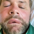Brian McFadden alarms fans after sharing video showing his horrific reaction to ‘bee sting’