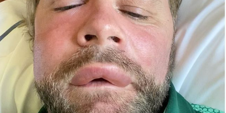 Brian McFadden alarms fans after sharing video showing his horrific reaction to ‘bee sting’