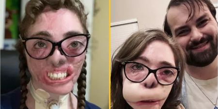 Dogsitter reveals results of reconstructive surgery after most of her face was torn off in dog attack