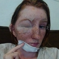 Woman’s freckles melted off after brother-in-law attacked her with boiling water during row over pet rat