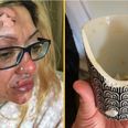 Mum left in ‘agony’ after following viral TikTok poached egg ‘hack’