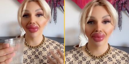 Woman who’s undergone huge lip injections says it’s difficult to eat and drink