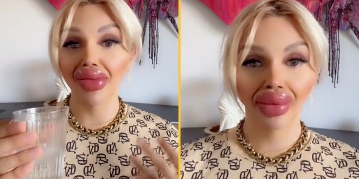 Woman who's undergone huge lip injections says it's difficult to eat and drink