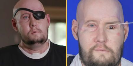 Man receives first-ever eye transplant after losing half his face in electrocution