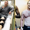 Mark Zuckerberg undergoes surgery after being injured while training for MMA fight