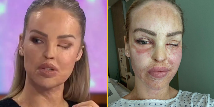 Katie Piper gives update after her eye is sewn shut for a year