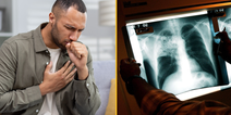Warnings issued over rise of TB cases in the UK
