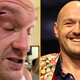 Tyson Fury may never fight again according to former champion