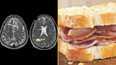 Man discovers headaches caused by parasite in his brain from not cooking crispy bacon
