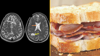 Man discovers headaches caused by parasite in his brain from not cooking crispy bacon